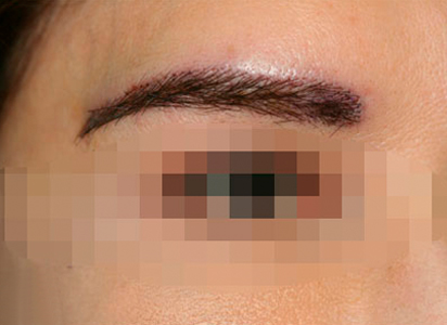Eyebrow Transplant Procedure After Result 1