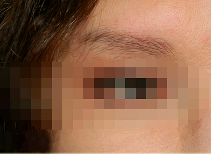 Eyebrow Transplant Procedure Before Result 1