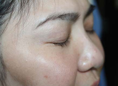 Eyelash Transplant Procedure Before Result 3