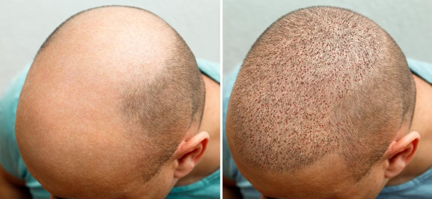 Hair Transplant to Reclaim Strength and Boldness Instantly